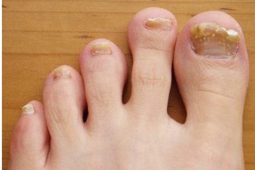 Fungal nail example